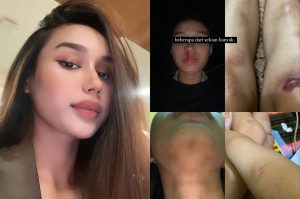 Viral Mahasiswi UPH Tangerang Diduga Dianiaya Mantan Pacar