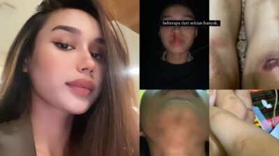 Viral Mahasiswi UPH Tangerang Diduga Dianiaya Mantan Pacar, Dibanting dan Dicekik Sampai Babak Belur